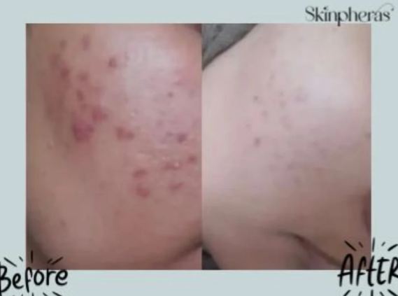 Acne before after close up