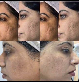 Acne scar before after collage