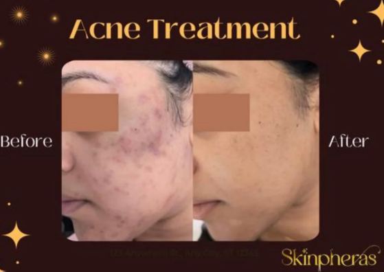 Acne before after example