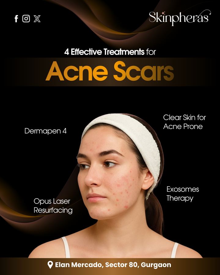 Skinpheras acne scar treatment options