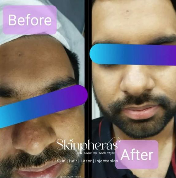 Skinpheras anti-ageing before after reference