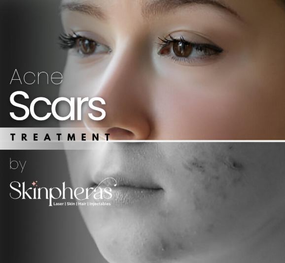 Acne scars treatment graphic