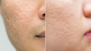 Acne Scars Treatment in Skinpheras Clinic